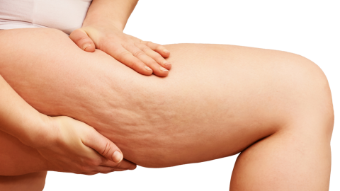 Close-up of a woman’s thigh with her hand squeezing around visible cellulite, illustrating natural skin texture for blog content on cellulite awareness, body positivity, and natural treatment options